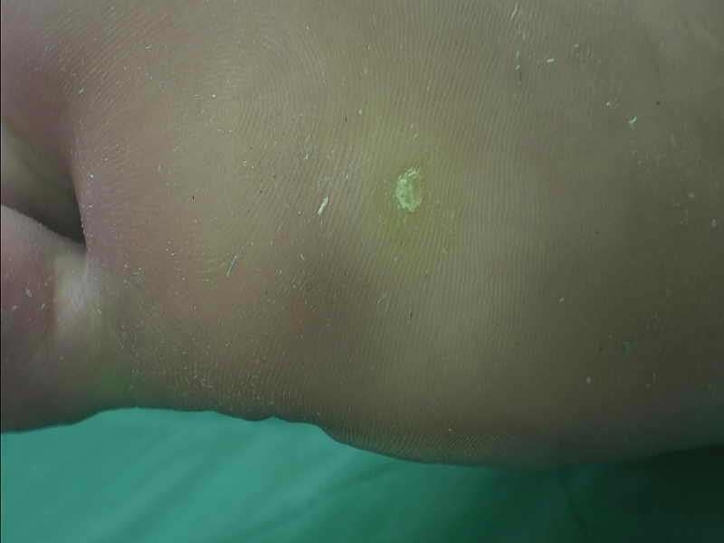 Bomyung Clinic clinical reference image showing a plantar wart on the sole